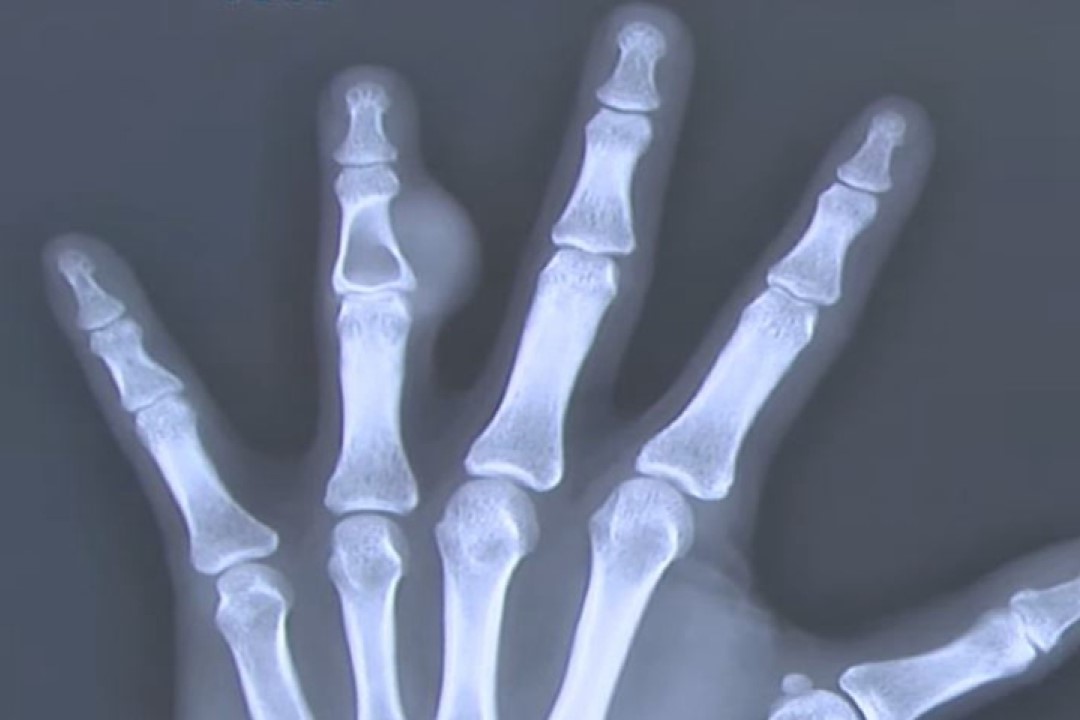 Benign Bone Tumor