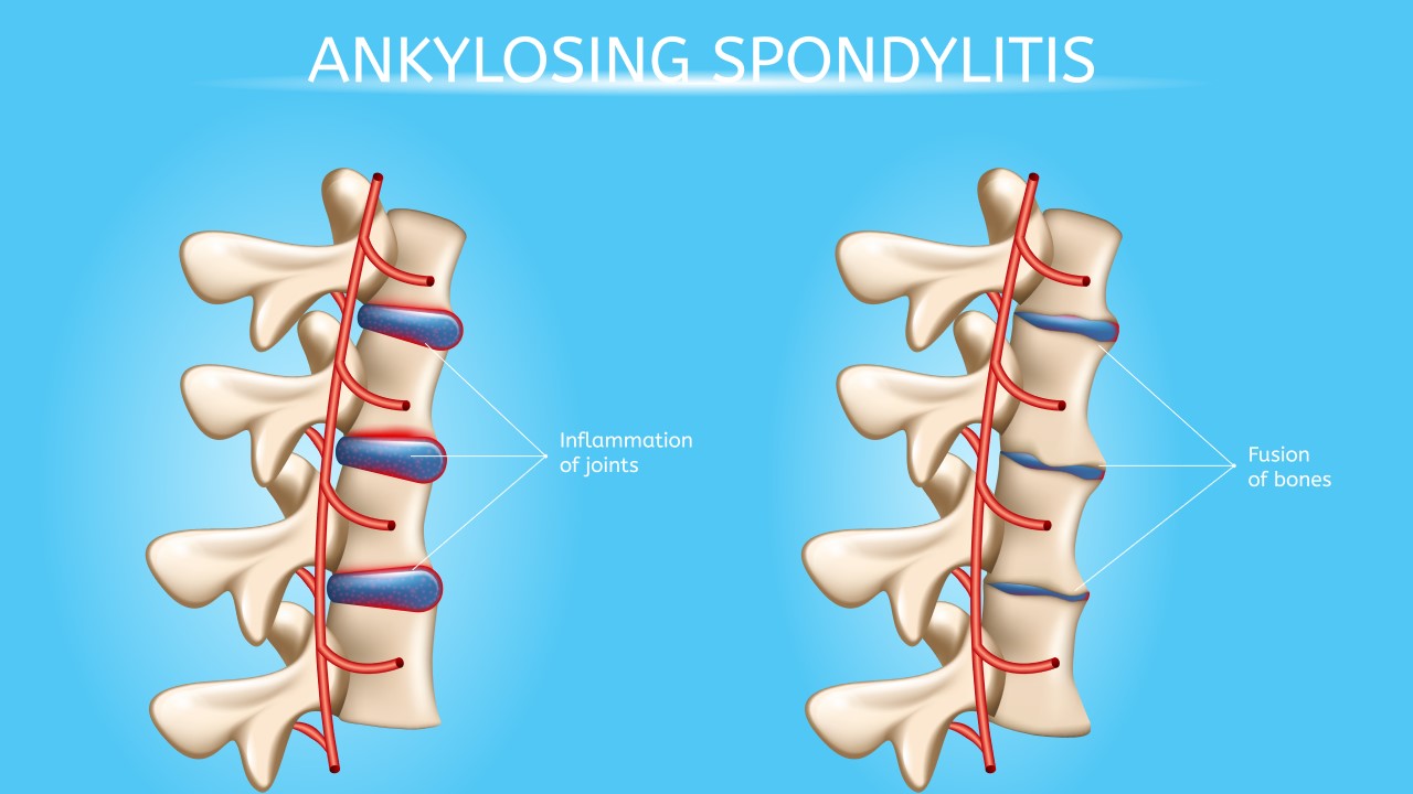 Ankylosing Spondylitis (Part 2)