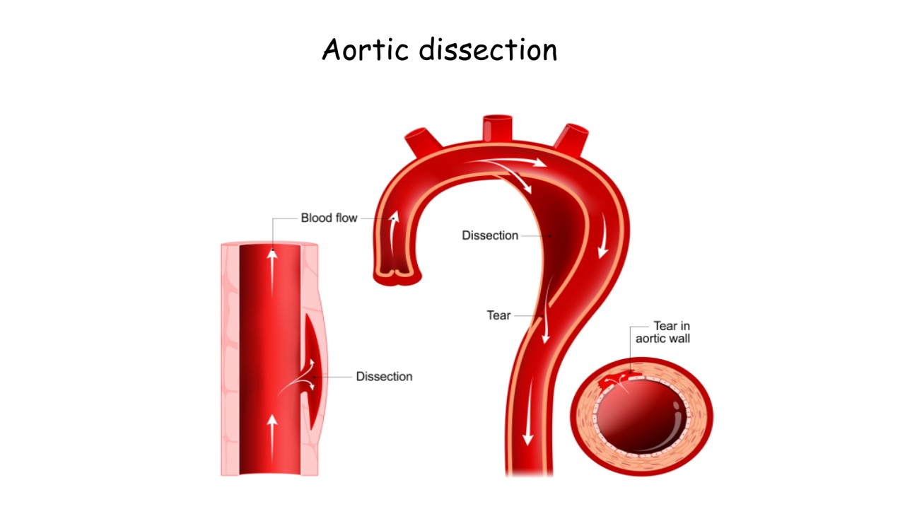 Aortic Dissection