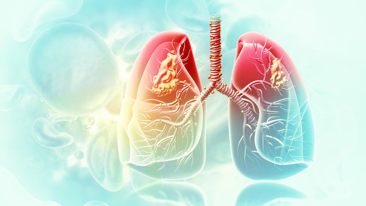 Early Detection of Lung Cancer