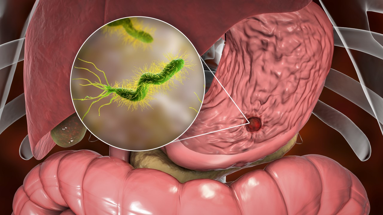 Helicobacter Pylori