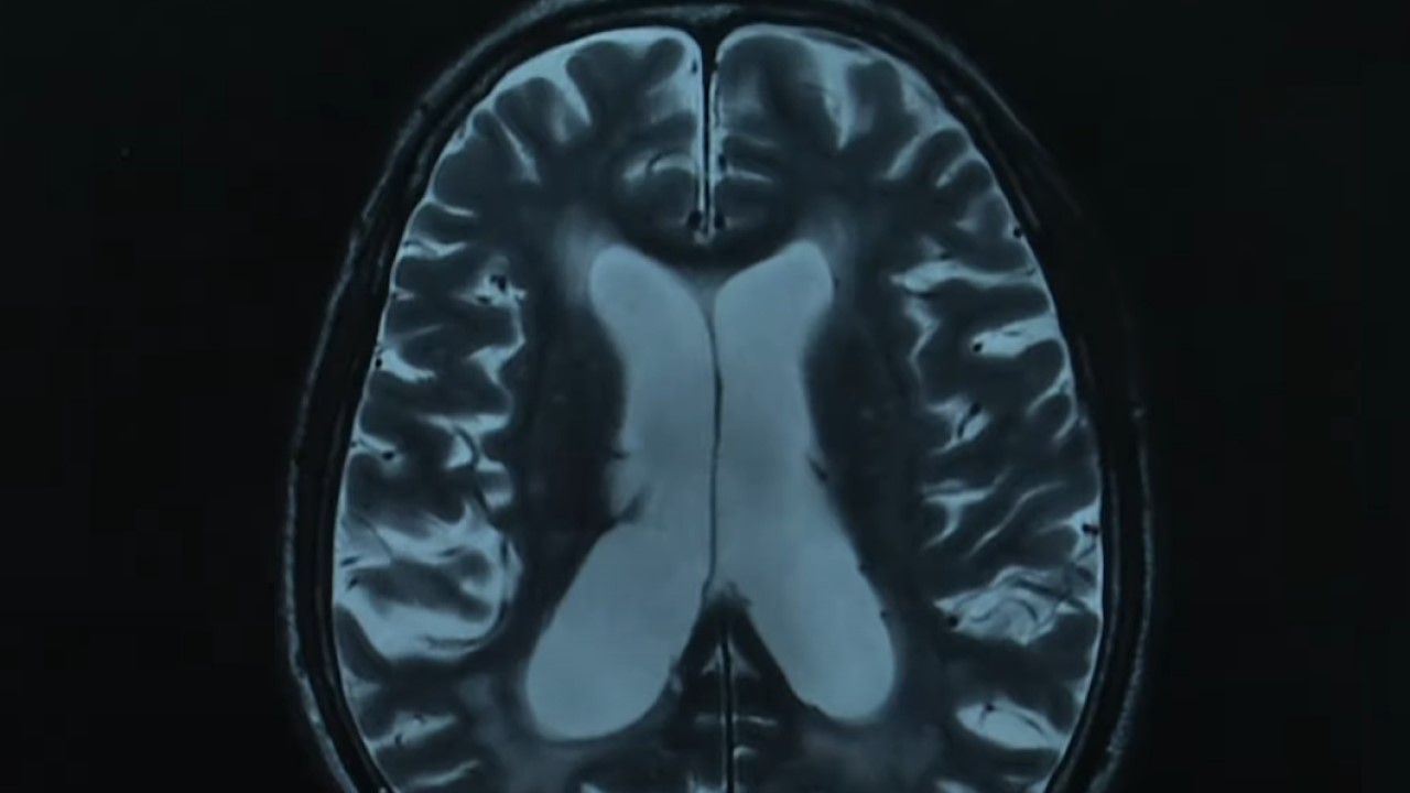 Hydrocephalus