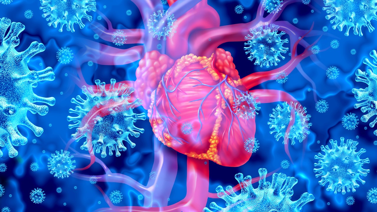 Infective Endocarditis