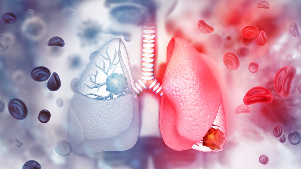 Lung Cancer
