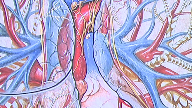 Mediastinal Tumor