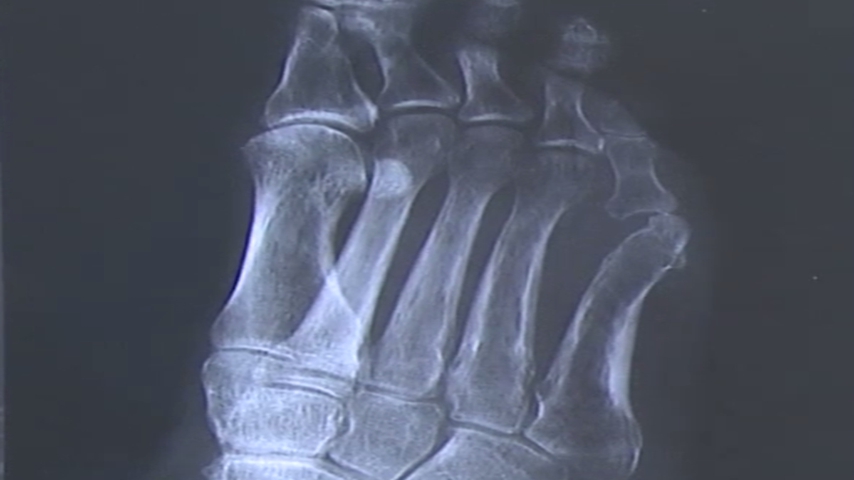 Osteomyelitis