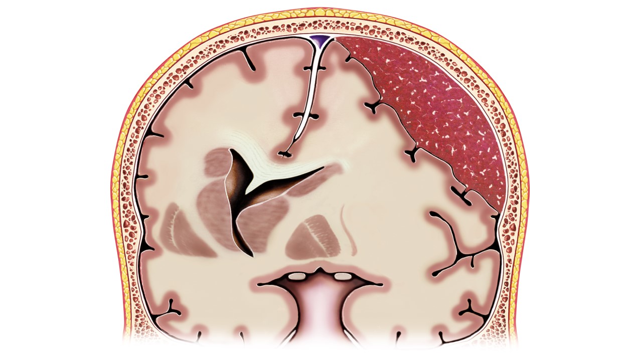 Subdural Hematoma