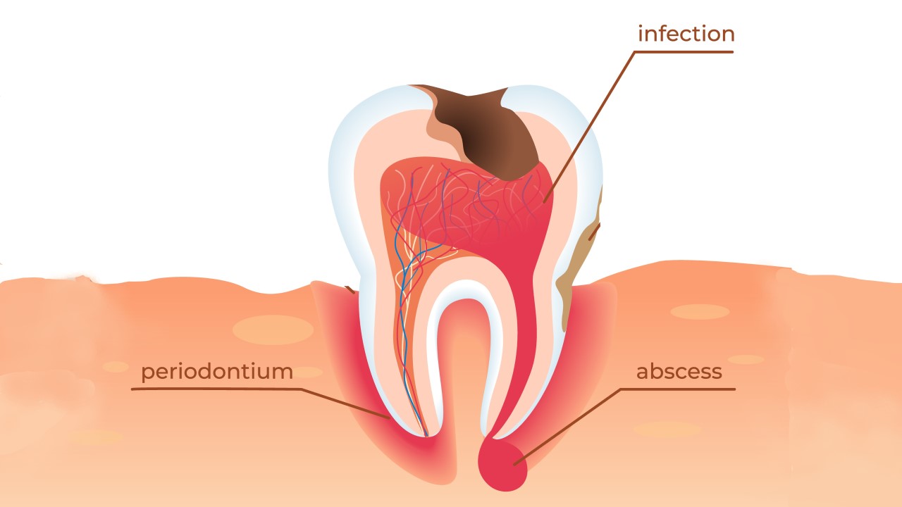 Tooth Root Infection