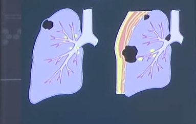 Colorectal Cancer and Lung Cancer