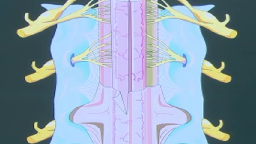 Spinal Tumors