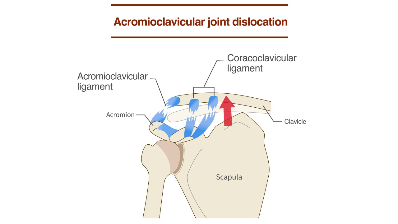 AC Joint Separation