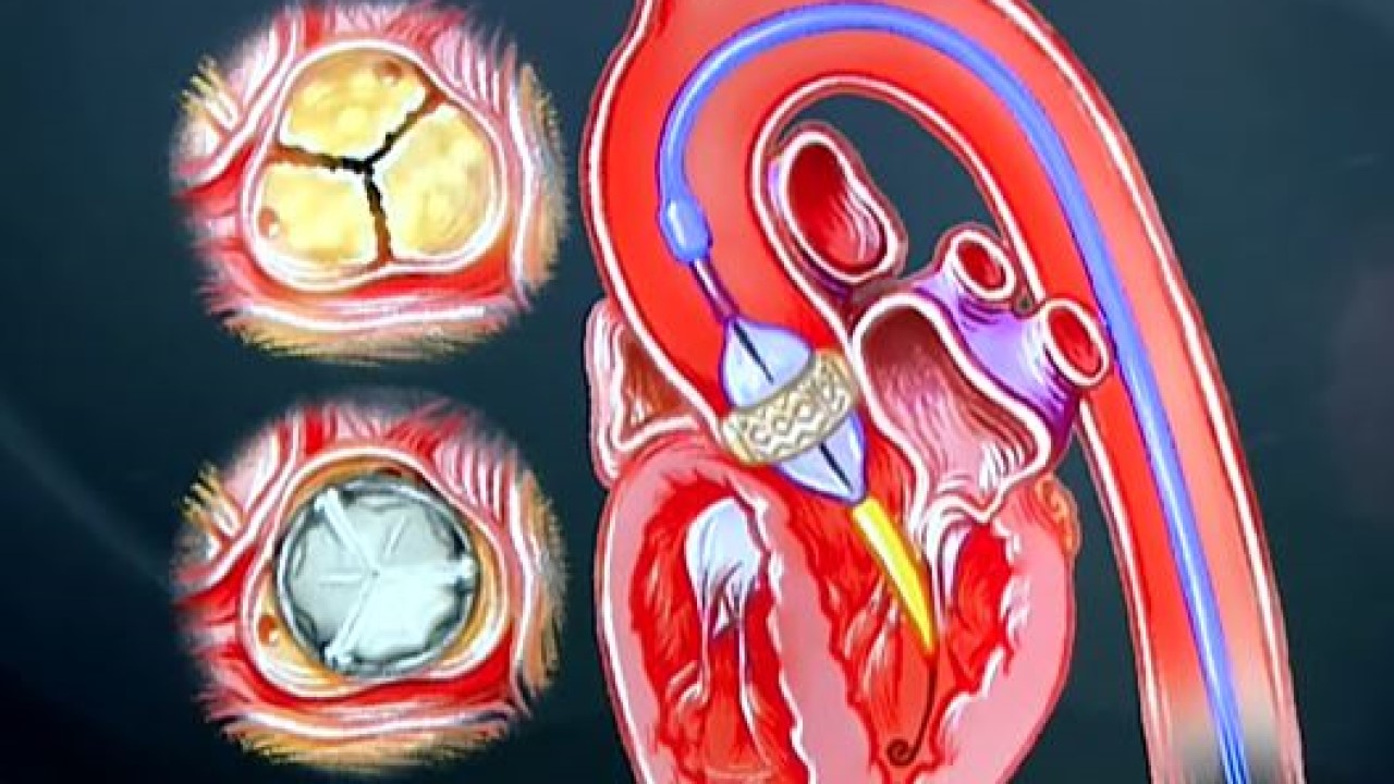 Aortic Valve Replacement