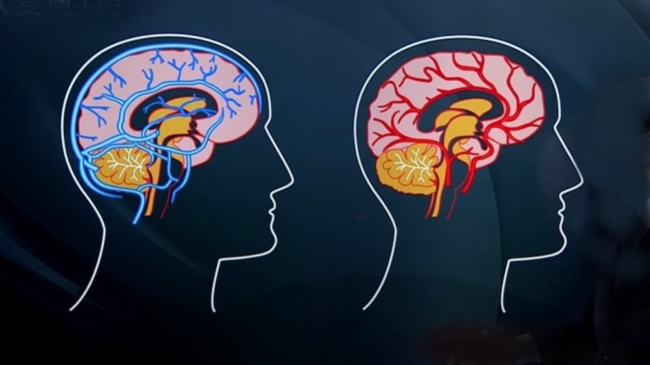 Cerebral Venous Sinus Thrombosis