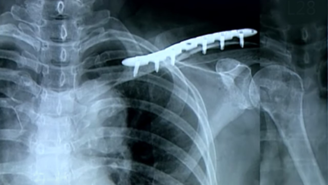 Clavicle Fracture