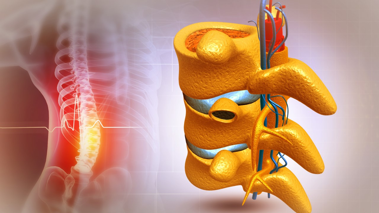 Spondylolisthesis