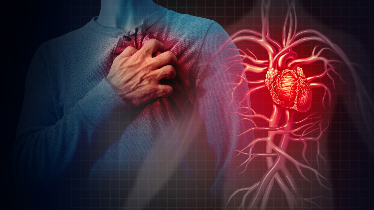 Coronary Artery Disease