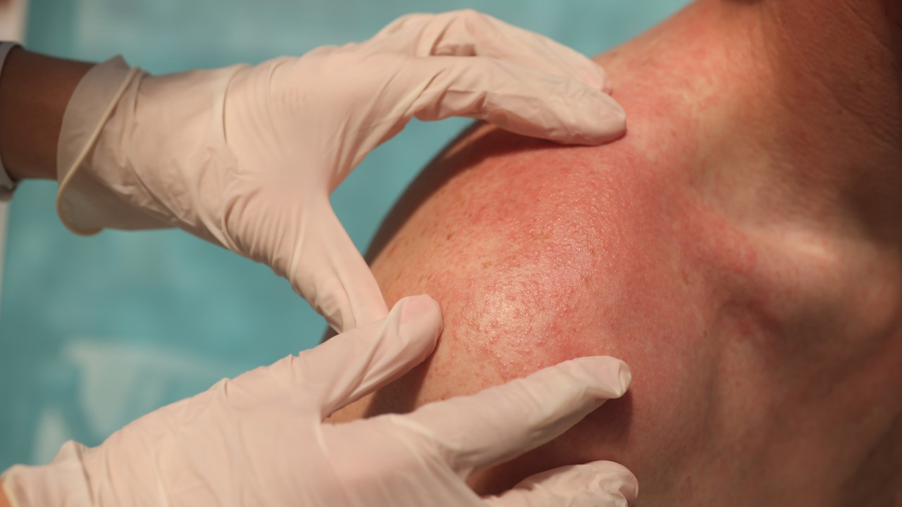 Dermatomyositis (Part 2)