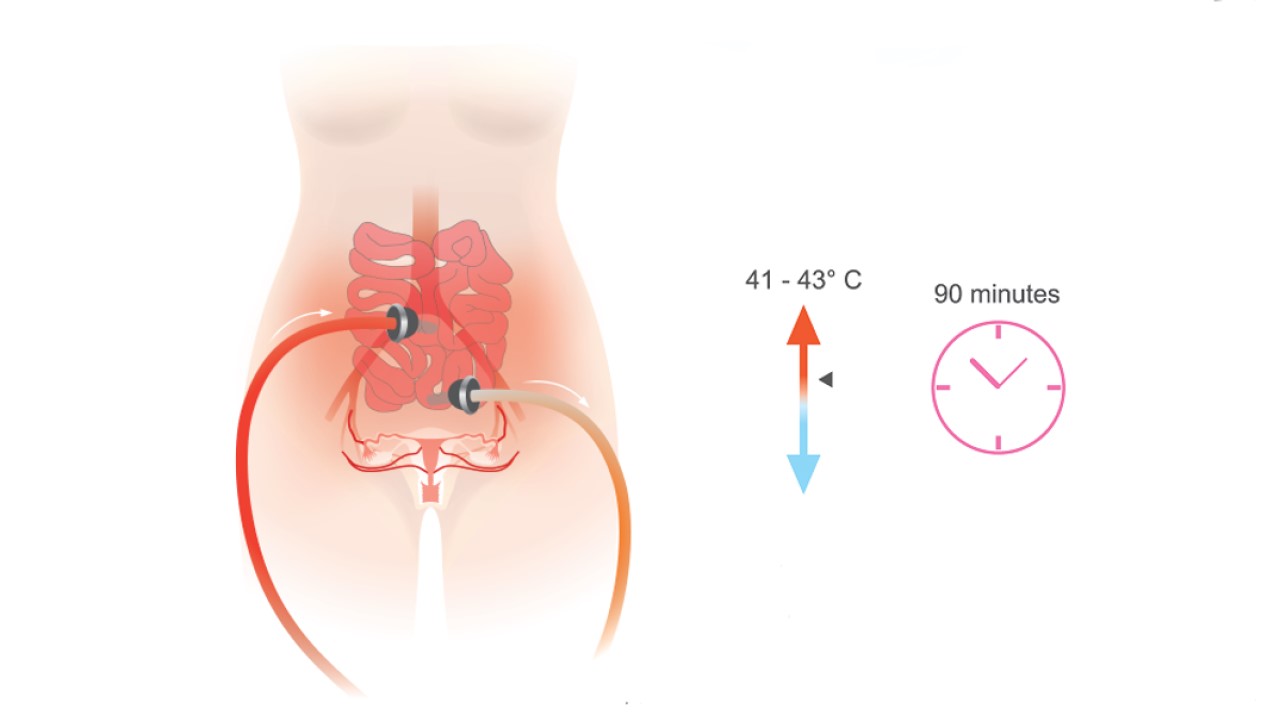 Hyperthermic Intraperitoneal Chemotherapy (HIPEC) (Part 2)