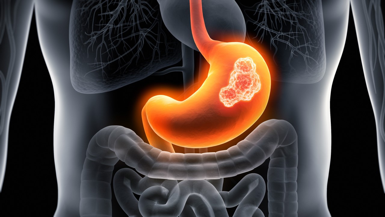 Hyperthermic Intraperitoneal Chemotherapy (HIPEC) (Part 3)