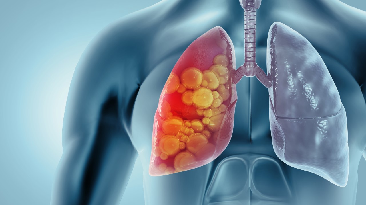 What Causes Lung Cancer