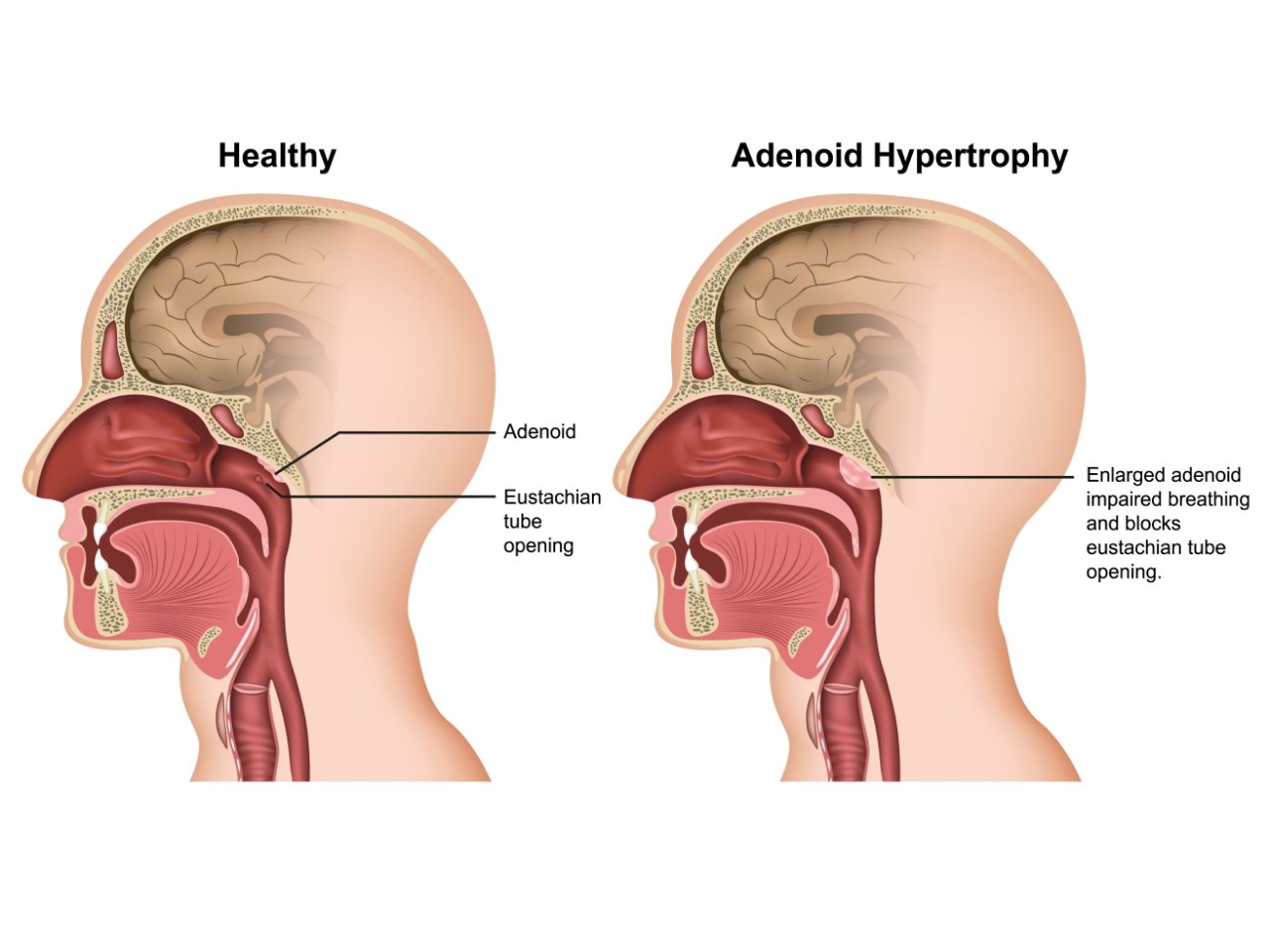 Adenoid Hypertrophy