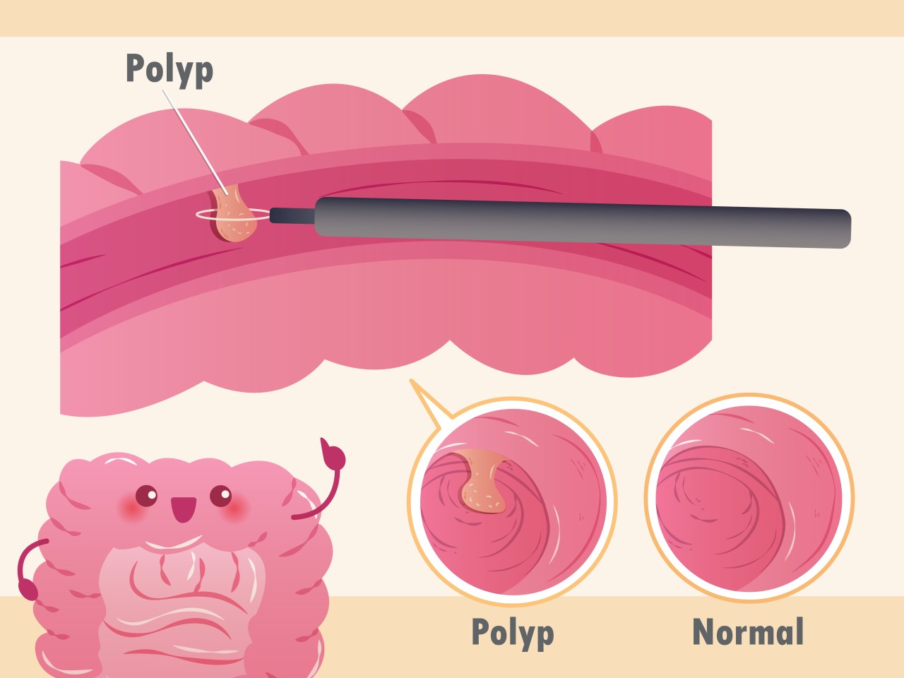 Colon Polyps