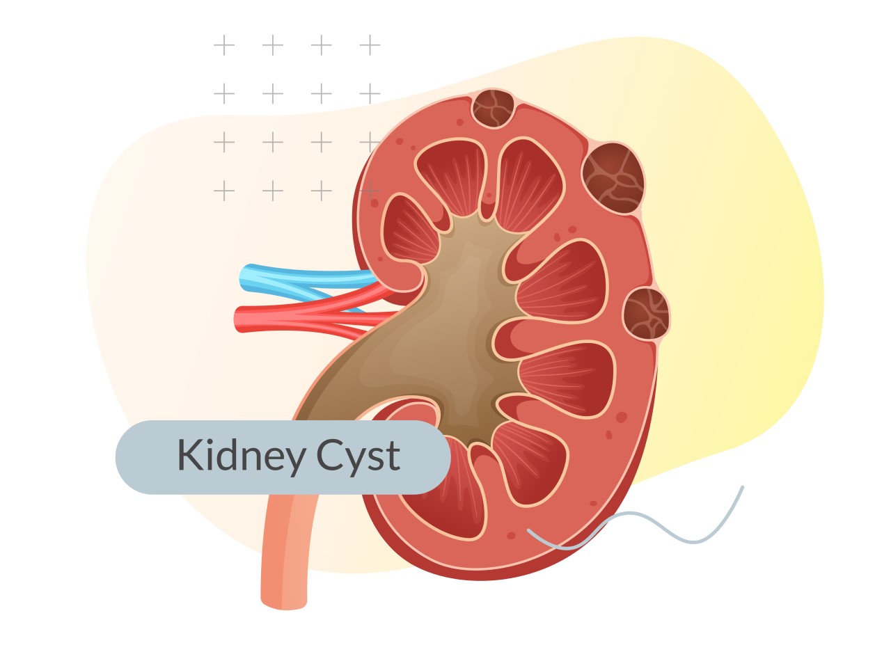 Kidney Cyst