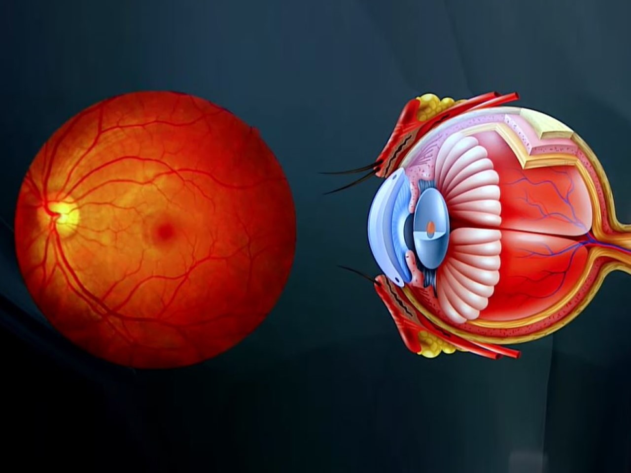 Retinal Bleeding