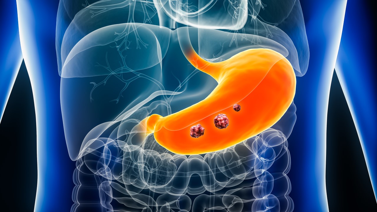 Reversing Gastric Cancer