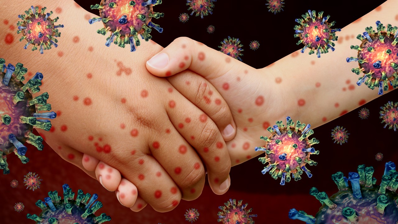 Measles (Part 2)