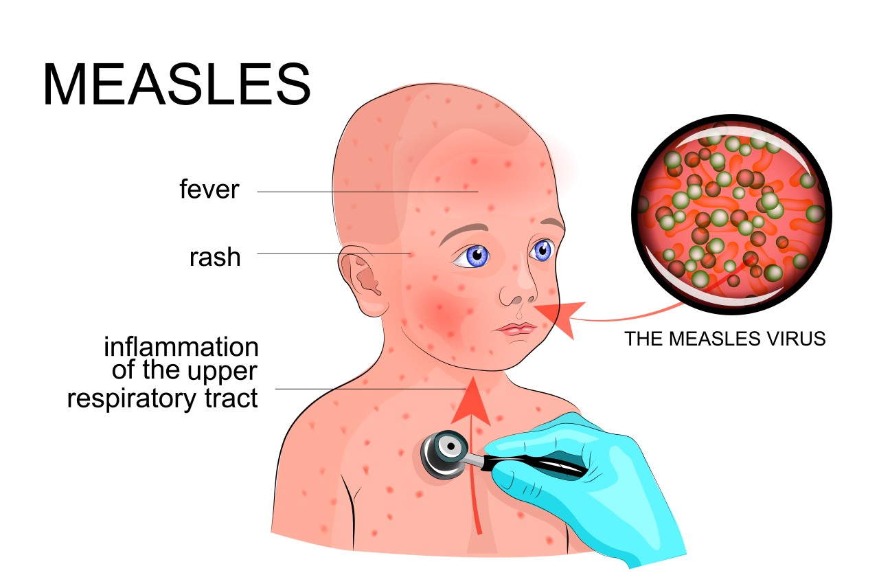Measles (Part 3)