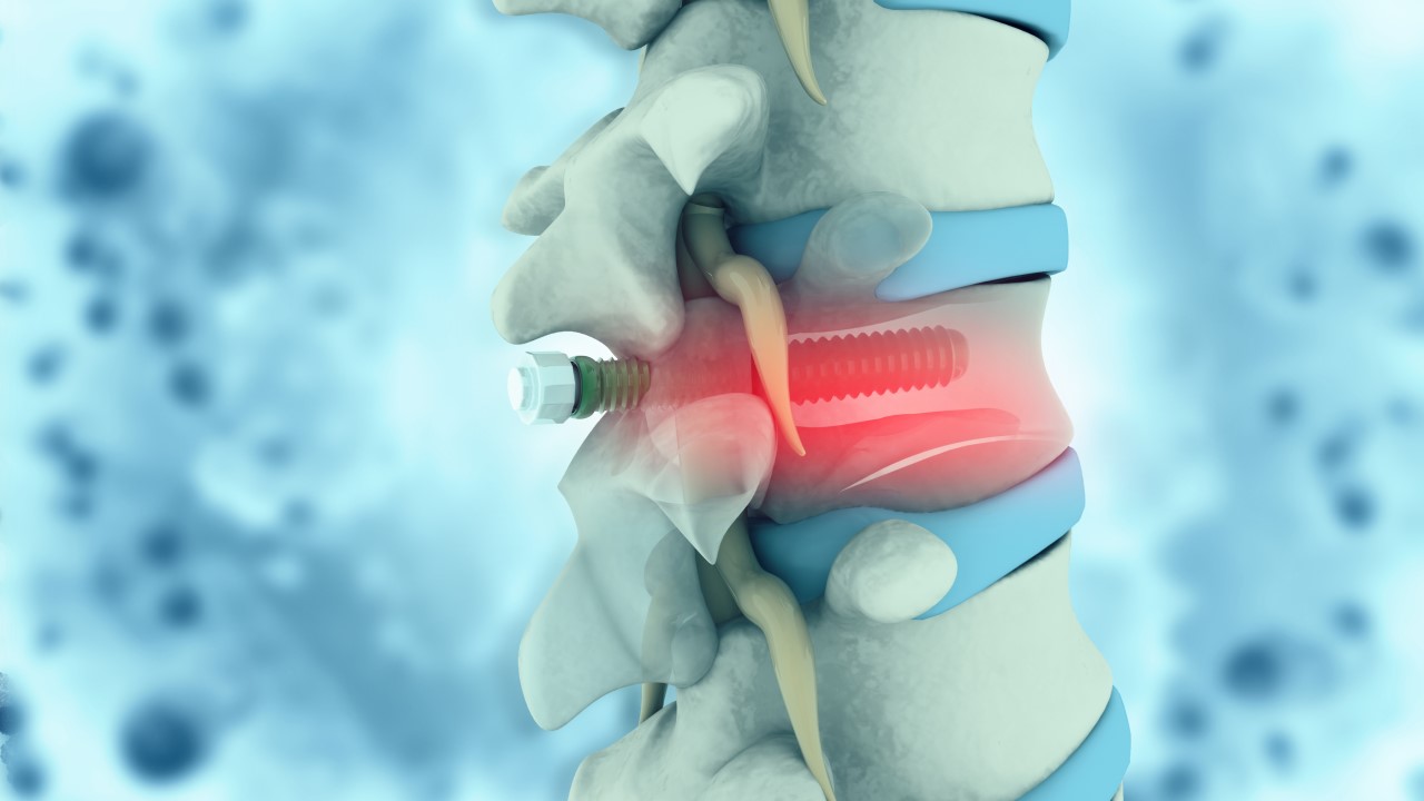 Herniated Disc and Spinal Stenosis