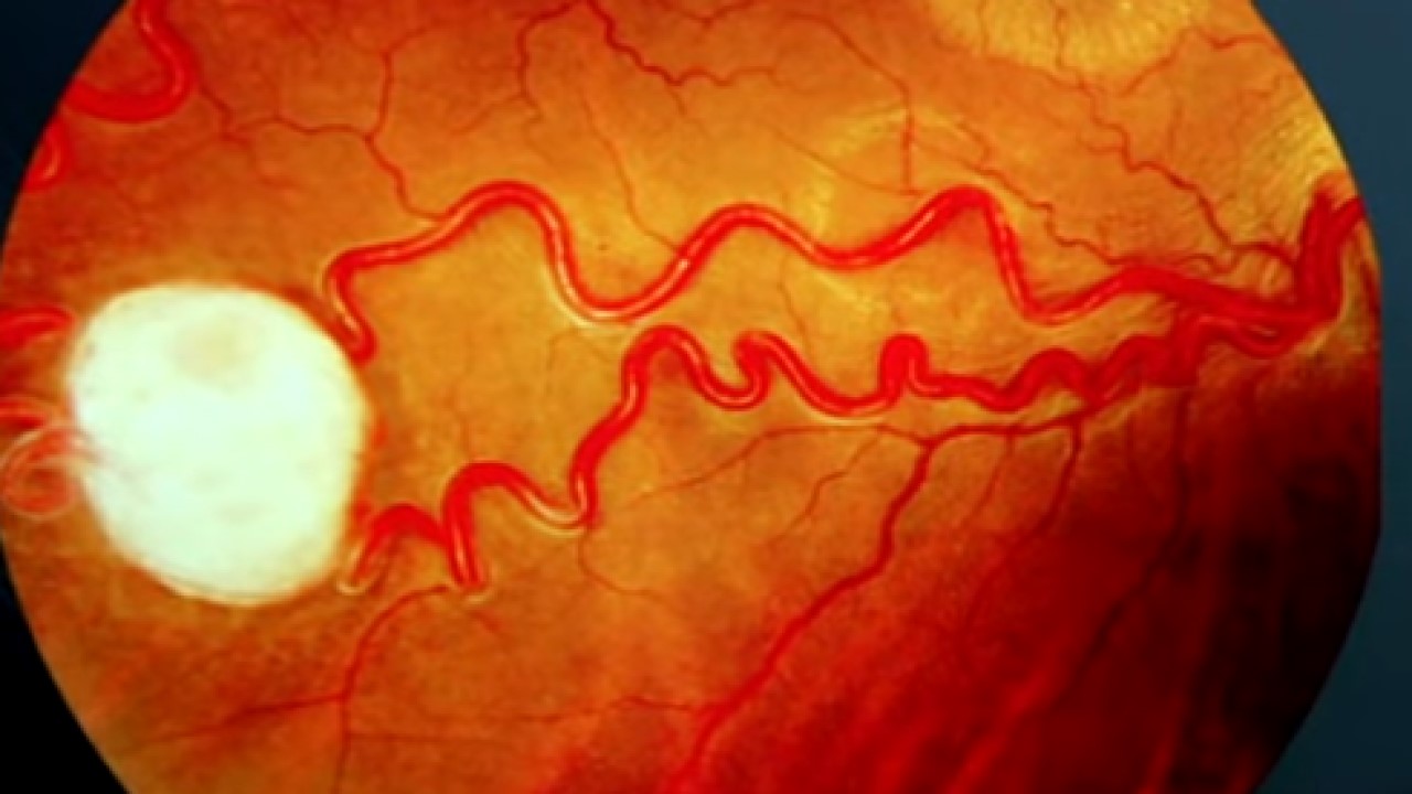 Retinal Angioma